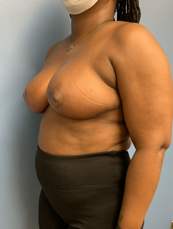 Breast Reduction case #2834