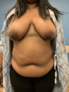 DIEP Flap case #2655