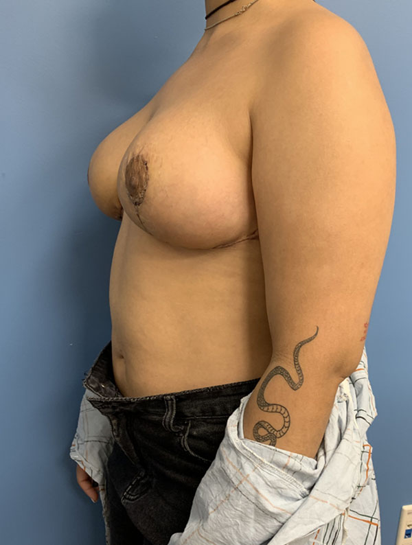 Breast Reduction case #2844