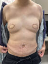 DIEP Flap case #2662