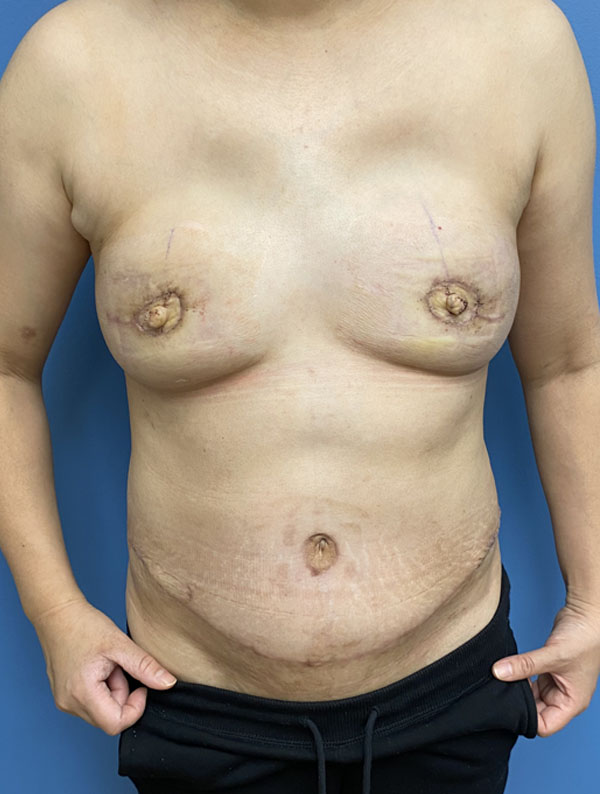 DIEP Flap case #2662