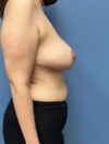 Breast Reduction case #2856