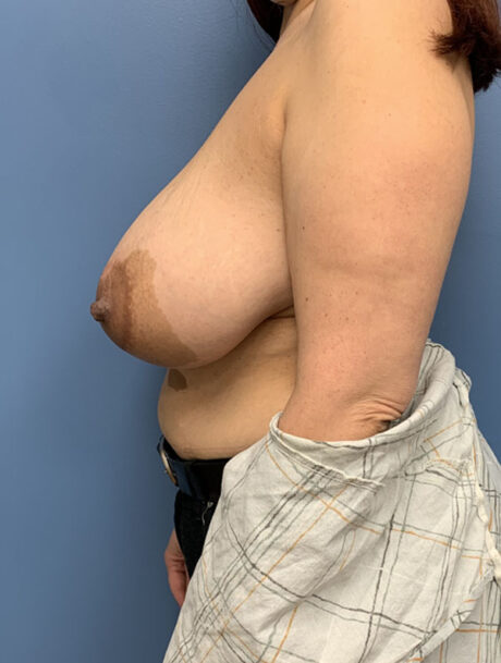 Breast Reduction case #2856