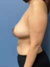 Breast Reduction case #2856