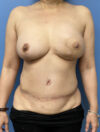 DIEP Flap case #2666