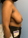 Breast Reduction case #2866