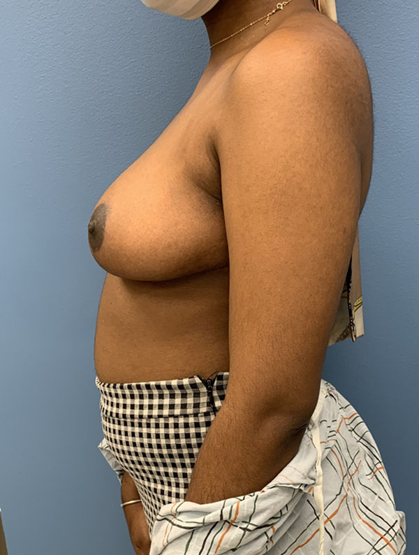 Breast Reduction case #2866