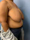 Breast Reduction case #2878
