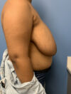 Breast Reduction case #2878