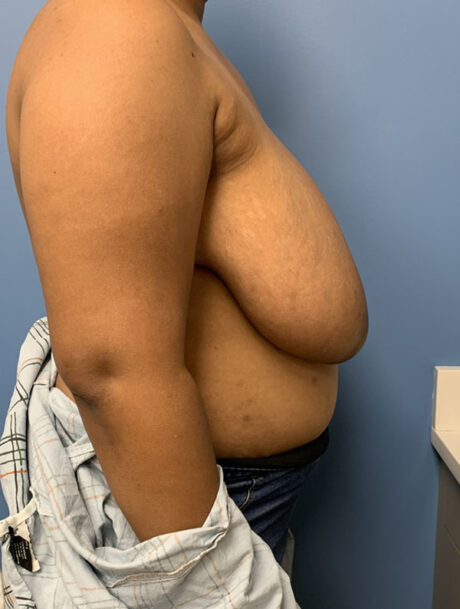 Breast Reduction case #2878