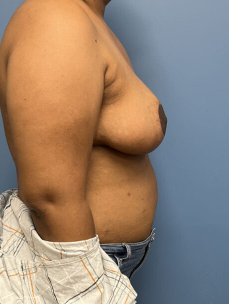 Breast Reduction case #2878
