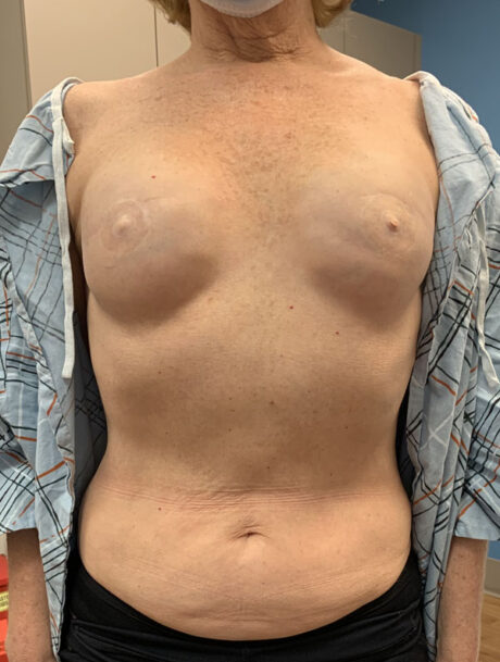DIEP Flap case #2671