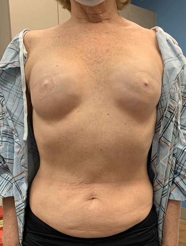 DIEP Flap case #2671