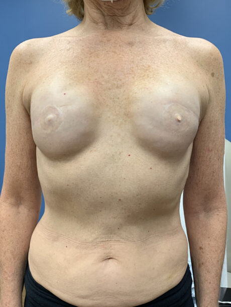 DIEP Flap case #2671