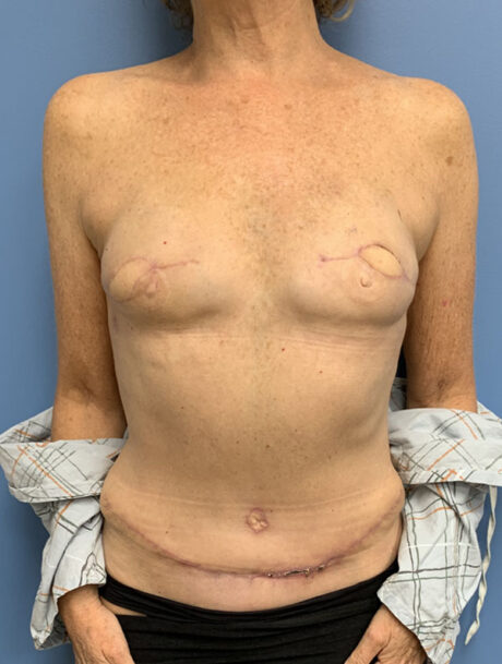 DIEP Flap case #2671