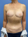 DIEP Flap case #2671