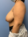 Breast Reduction case #2888
