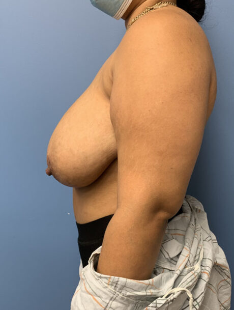 Breast Reduction case #2888