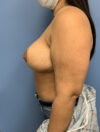 Breast Reduction case #2888