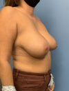 Breast Reduction case #2900