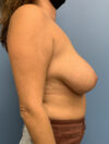 Breast Reduction case #2900
