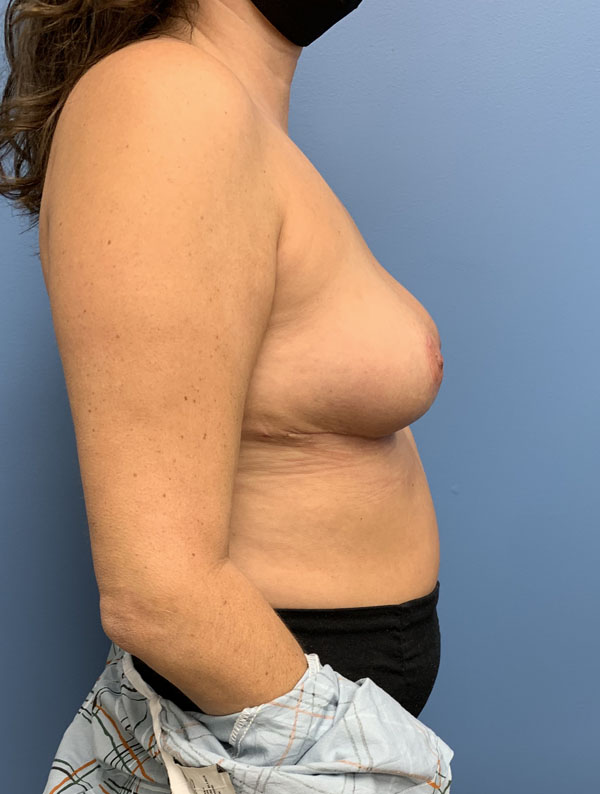 Breast Reduction case #2900