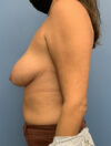 Breast Reduction case #2900