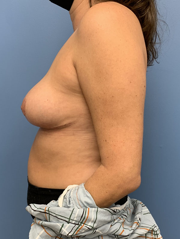 Breast Reduction case #2900