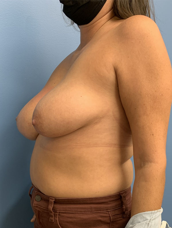 Breast Reduction case #2900