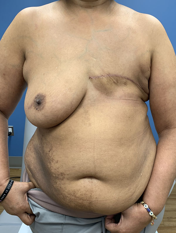 DIEP Flap case #2682