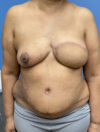 DIEP Flap case #2682