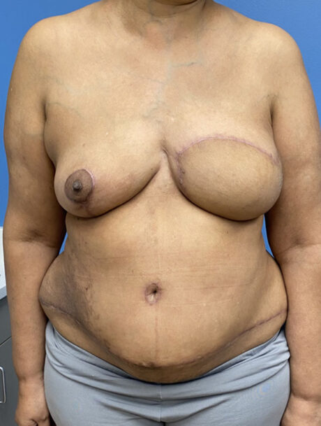 DIEP Flap case #2682
