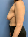Breast Reduction case #2922