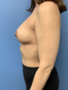 Breast Reduction case #2922