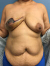 DIEP Flap case #2604
