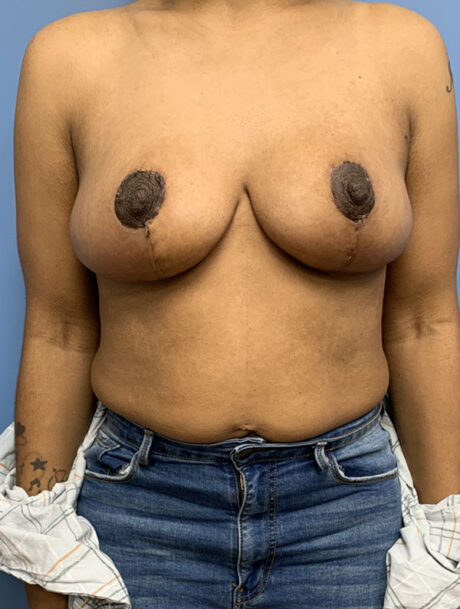 Breast Lift case #2712