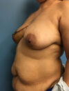DIEP Flap case #2604