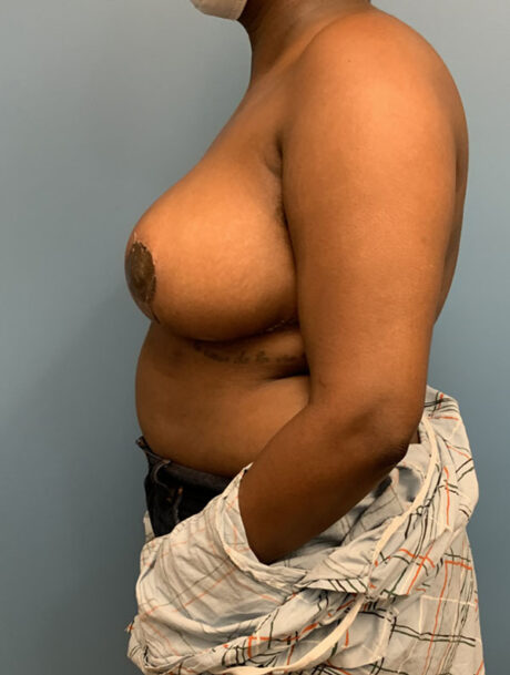 Breast Reduction case #2734