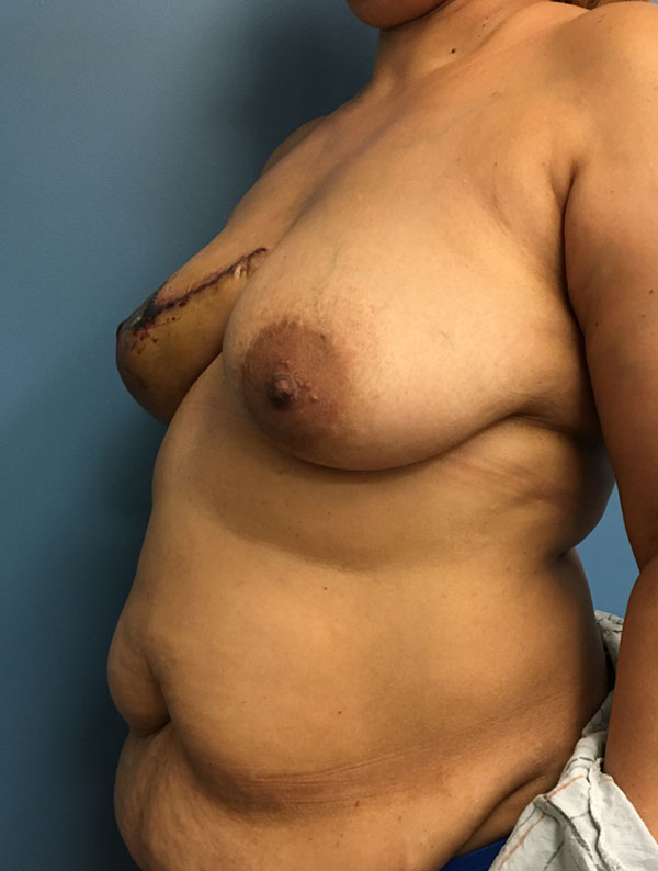 DIEP Flap case #2604