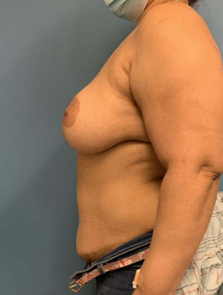 DIEP Flap case #2604