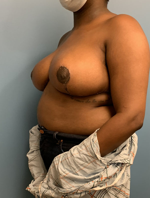 Breast Reduction case #2734