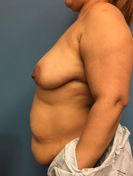 DIEP Flap case #2604