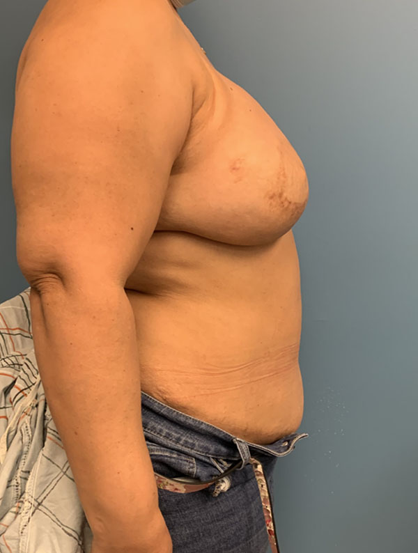 DIEP Flap case #2604