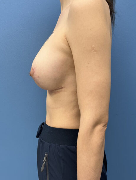 Breast Augmentation case #2698