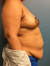 DIEP Flap case #2604