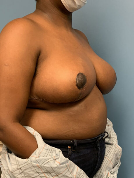 Breast Reduction case #2734