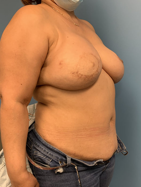 DIEP Flap case #2604