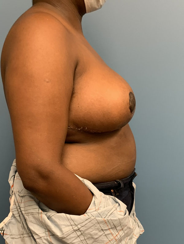 Breast Reduction case #2734