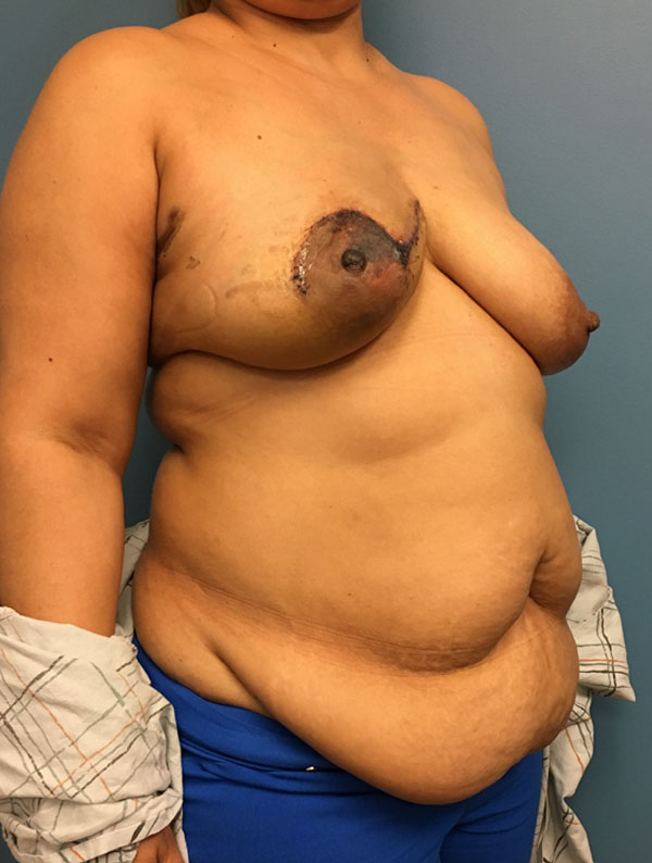 DIEP Flap case #2604