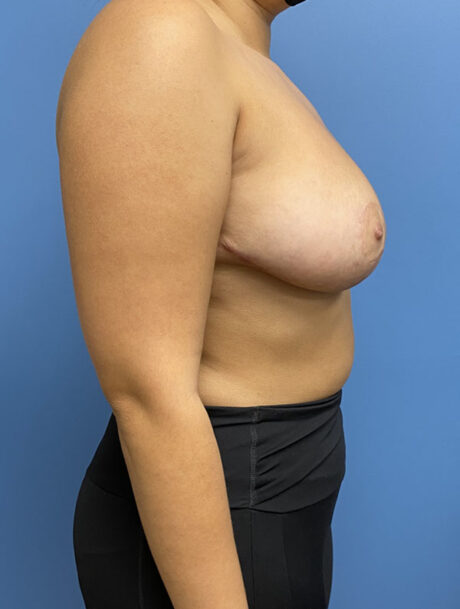 Breast Reduction case #2932